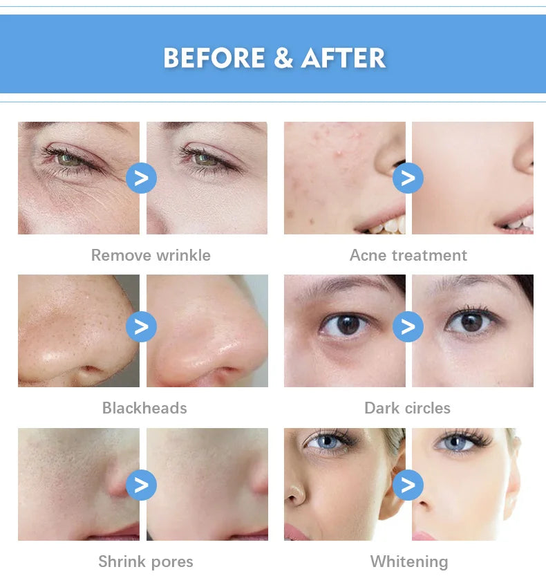 High Quality Smart Ice Blue Facial Treatment Machine 2025 Hydrofacial 7 in 1 Professional  Portable Dermabrasion
